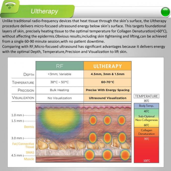 ultherapy HIFU, σύστημα ulthera, δέρμα που ανυψώνει, αφαίρεση ρυτίδων, εμπειρία 5 ετών της εξαγωγής, εξουσιοδότηση 2years