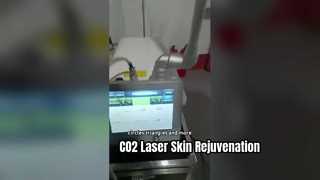 30W RF Tube Fractional Co2 laser για την αφαίρεση ουλών και την τέντωση του δέρματος